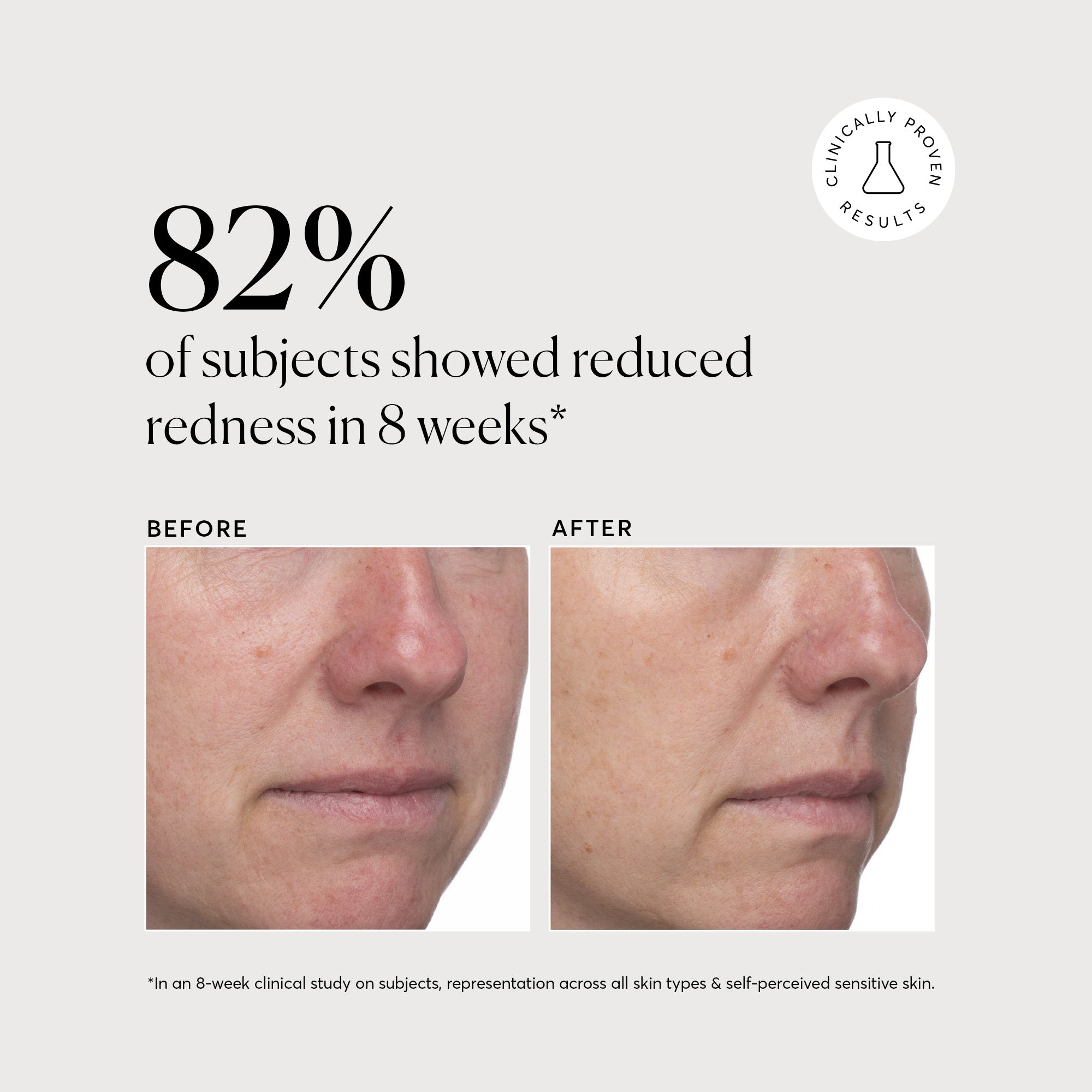 NATR_Azelaic_Acid_Clinical_Redness_B_A_Graphic_Bone_d7711eca-fec1-41a3-b2af-36264b7022b8